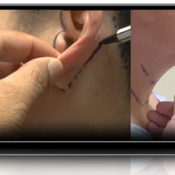 Deep Neck Lift & SubSMAS Facial Rejuvenation, 3-Volume Video Series