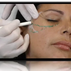 UMA Academy Advanced Filler Techniques Combining CaHA, HA and Hybrid Fillers