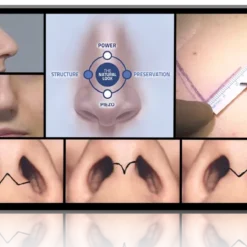 Hands‑On Open Rhinoplasty Masterclass: Achieving Subtle, Primary Hybrid Results for a Naturally Refined Nose